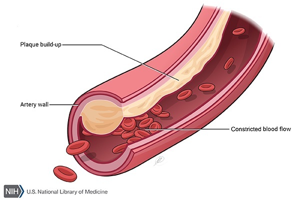 Plaque in an artery wall